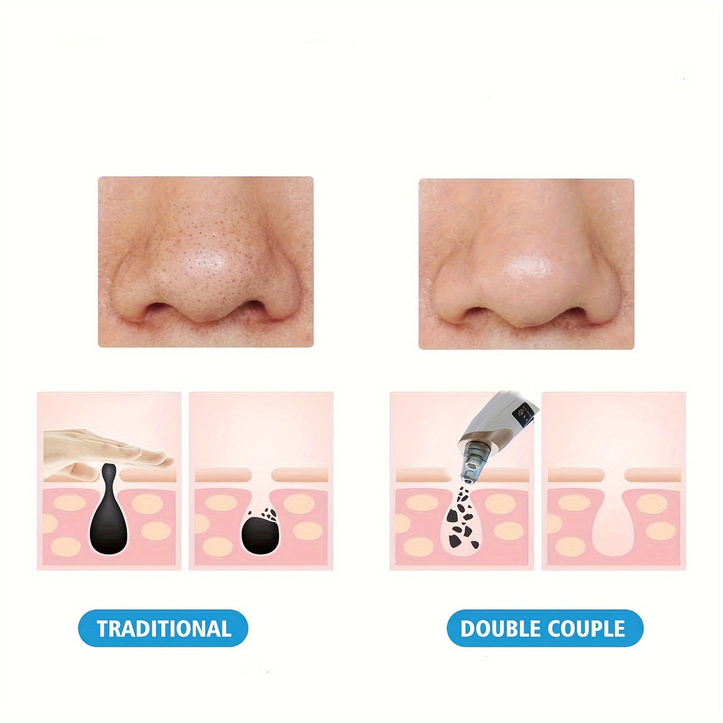 ClearPore Pro – Super Mitesser-Reduzierer